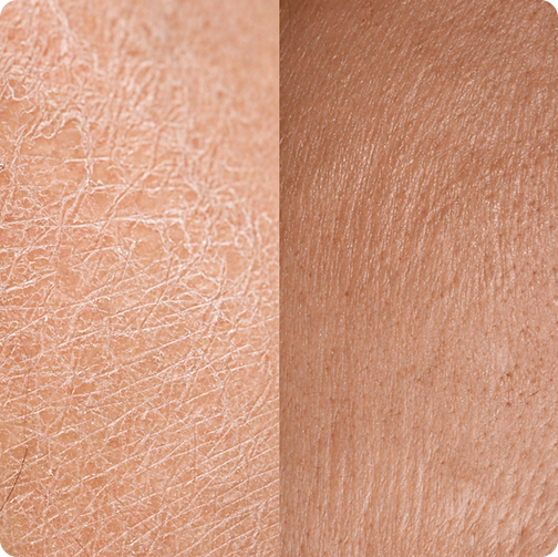 Split image: dry flaky skin on the left, dehydrated skin on the right